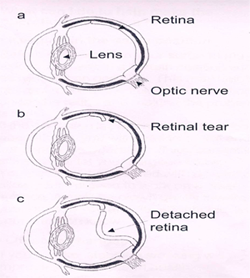 Types of Retinal Detachment, Their Causes, and Treatments