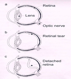 What is the Retina? Retinal detachment and other retinal issues.