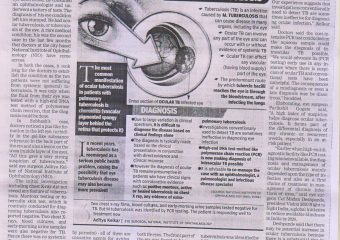 DR. ADITYA KELKARS ARTICLE ON RARE EYE TB