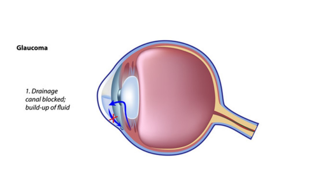 What is Glaucoma